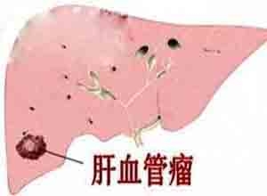 肝血管瘤病的预防和并发症有哪些？_血管瘤论坛-中国血管瘤患者之家