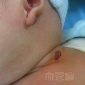 宝宝颈部血管瘤的分类_血管瘤论坛-中国血管瘤患者之家