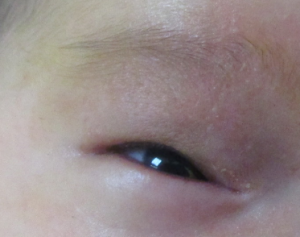 婴儿眼皮血管瘤怎么治疗?_血管瘤论坛-中国血管瘤患者之家