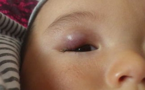 眼部血管瘤对眼睛有坏处吗?怎样治疗好呢?_血管瘤论坛-中国血管瘤患者之家