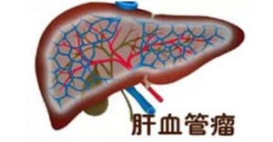 肝血管瘤的生长速度如何?_血管瘤论坛-中国血管瘤患者之家