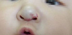 鼻部血管瘤的症状是哪些呢？_血管瘤论坛-中国血管瘤患者之家