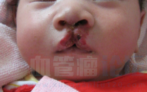 宝宝鼻子长了混合血管瘤的危害_血管瘤论坛-中国血管瘤患者之家