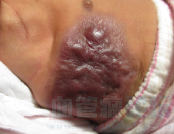 寶寶得了頭部蔓狀血管瘤怎么辦_血管瘤論壇-中國血管瘤患者之家