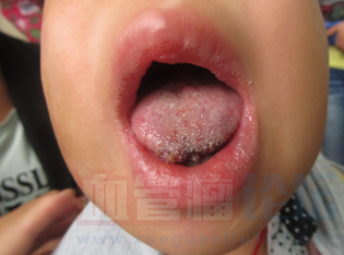 舌部血管瘤的症状表现_血管瘤论坛-中国血管瘤患者之家
