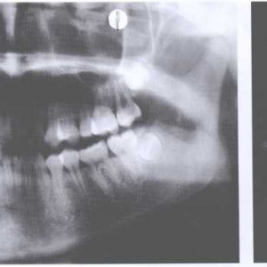 口腔頜面部脈管畸形常用影像學檢查（一）_血管瘤論壇-中國血管瘤患者之家