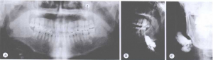 口腔颌面部脉管畸形常用影像学检查（二）_血管瘤论坛-中国血管瘤患者之家
