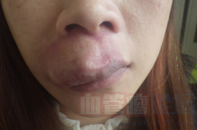嘴唇上有血管瘤该如何治疗？_血管瘤论坛-中国血管瘤患者之家