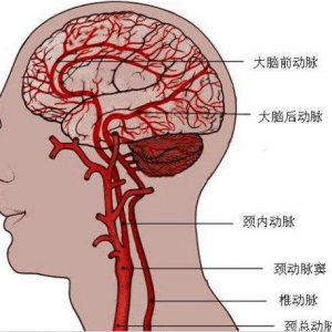 脑血管瘤的相关知识介绍_血管瘤论坛-中国血管瘤患者之家