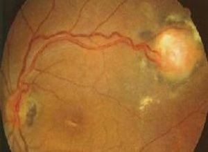 视网膜毛细血管瘤不同时期的症状表现_血管瘤论坛-中国血管瘤患者之家