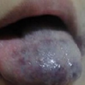 舌部血管瘤的形成原因有哪些？_血管瘤论坛-中国血管瘤患者之家