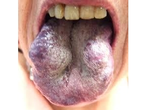舌部血管瘤的危害_血管瘤论坛-中国血管瘤患者之家