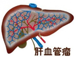 肝血管瘤对生活造成的危害有哪些？_血管瘤论坛-中国血管瘤患者之家