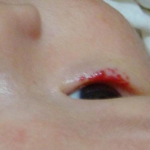 眼睛部位的毛细血管瘤该如何判断？_血管瘤论坛-中国血管瘤患者之家
