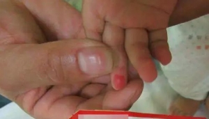 婴儿手指血管瘤的症状有哪些？_血管瘤论坛-中国血管瘤患者之家
