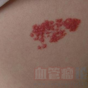 毛細血管瘤的形成因素_血管瘤論壇-中國血管瘤患者之家
