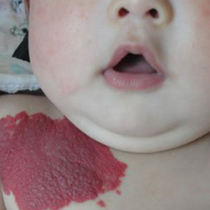 嬰幼兒血管瘤的治療方案_血管瘤論壇-中國血管瘤患者之家
