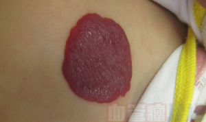 注射治疗或口服药物治疗的不良反应及并发症_血管瘤论坛-中国血管瘤患者之家