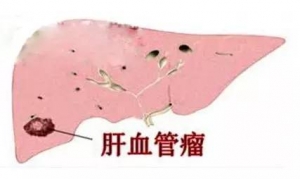 肝血管瘤的发病原因_血管瘤论坛-中国血管瘤患者之家