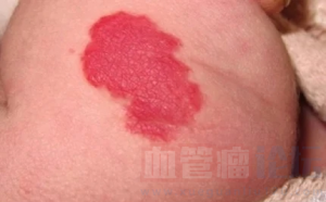 草莓状血管瘤的危害_血管瘤论坛-中国血管瘤患者之家