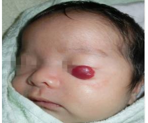 婴儿眼部血管瘤的病因和症状有哪些？_血管瘤论坛-中国血管瘤患者之家