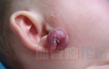 耳朵上会发生哪些类型的血管瘤呢？_血管瘤论坛-中国血管瘤患者之家