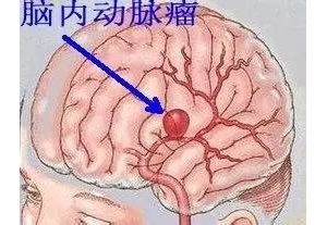 脑血管瘤的四大症状要当心_血管瘤论坛-中国血管瘤患者之家