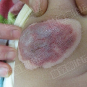 腿部混合型血管瘤的症状及危害_血管瘤论坛-中国血管瘤患者之家