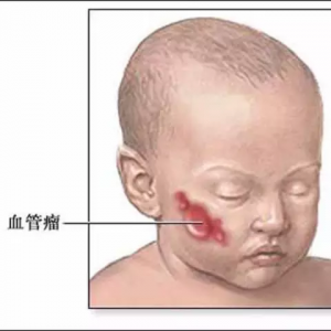 血管瘤更青睞嬰幼兒_血管瘤論壇-中國血管瘤患者之家