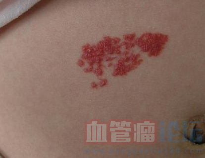 毛細血管瘤的常見癥狀_血管瘤論壇-中國血管瘤患者之家