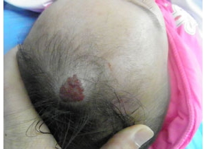 嬰兒頭部血管瘤常見分類_血管瘤論壇-中國血管瘤患者之家