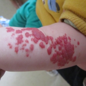 手臂上的红斑有些凸出是血管瘤吗？_血管瘤论坛-中国血管瘤患者之家