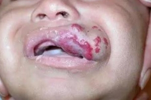 宝宝流口水会对嘴角的血管瘤产生影响吗？_血管瘤论坛-中国血管瘤患者之家