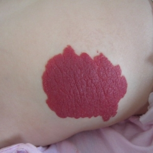 婴幼儿血管瘤（草莓状血管瘤）对孩子有哪些危害？_血管瘤论坛-中国血管瘤患者之家
