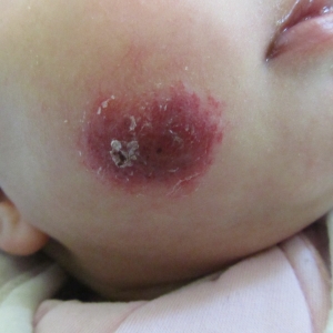 儿童脸部血管瘤的治疗误区_血管瘤论坛-中国血管瘤患者之家
